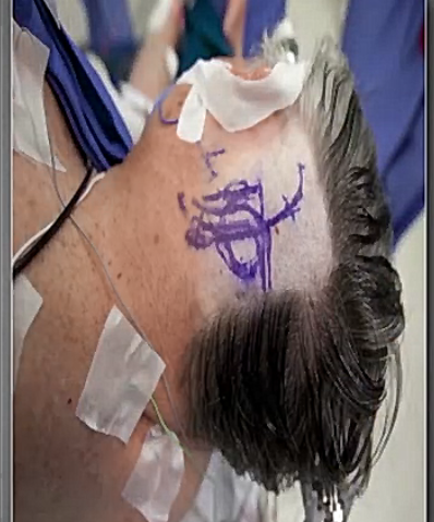 【视频交流】国际神经外科学院主席Couldwell教授内镜治疗少见的纯脑室内颅咽管瘤