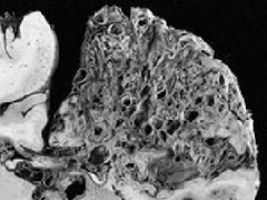 儿童脑动静脉畸形手术成功率