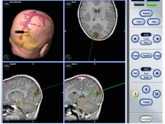 胶质母细胞瘤能治好吗？恶性脑肿瘤的纳米外科切除