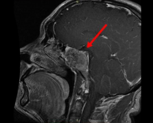 治疗脑脊索瘤有哪些比较好的方法?