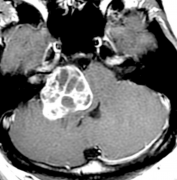 问：听神经瘤的主要临床表现有哪些？听神经瘤术后有后遗症吗？