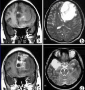 什么人群易患胶质瘤?胶质瘤死亡率