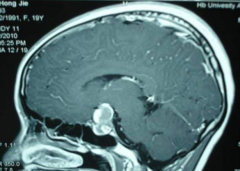 问：垂体瘤会缩短预期寿命吗？