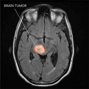 脑部胶质瘤治疗方法有哪些？INC三位脑胶质瘤国际手术大师详解