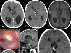 问：颅咽管瘤术后会不会复发？