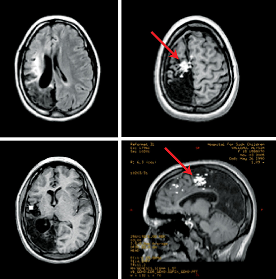 什么样的儿童癫痫病可以手术？