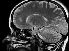 脊髓肿瘤除了腰痛还有什么症状？如何治疗？