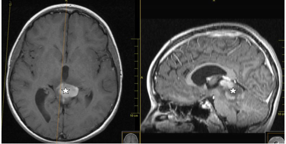 脑胶质瘤案例