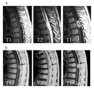 什么是脊髓肿瘤？MRI核磁影像如何解读瘤种？