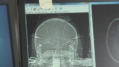 巴罗神经学研究所帕金森病治疗上的突破改变了患者的生活