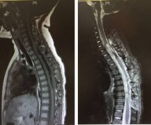 干细胞疗法“包治”百种肿瘤?干细胞治疗后却患上脊髓肿瘤