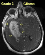 恶性脑瘤3-4级手术治疗后的生存期