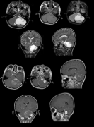 问：毛细胞型星形细胞瘤严重吗？如何治疗？
