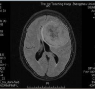 良性脑瘤开颅手术治疗后能活多久？