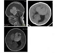 10个月胶质瘤宝宝如何活下去？INC三位海外儿童神外专家给予存活生机