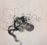 出国看病：脑动静脉畸形能痊愈吗？