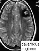 问：什么是脑海绵状血管瘤？