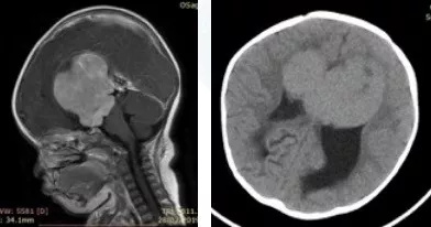 鞍区胶质瘤案例——术前