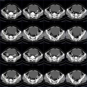 头部脊索瘤手术治疗后出国质子治疗