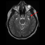 脑海绵状血管瘤的处理：手术还是保守？
