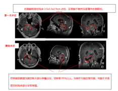 脑干胶质瘤质子刀治疗怎么样?