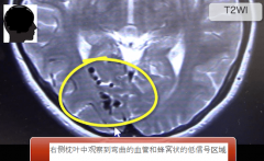 问：什么是脑动静脉畸形（AVM）？MRI成像的重点是什么？