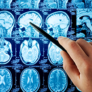 问：癫痫发作的前兆有哪些？发作时会发生什么？