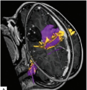 神经导航和神经监测在癫痫手术中的应用