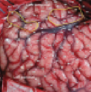 INC专家Rutka教授发现：MEG评估儿童顽固性癫痫手术后的正常或非局灶性MRI表现