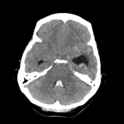 问：妊娠和产褥期会增加脑动静脉畸形破裂的风险吗？