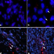 研究人员发现了与1型神经纤维瘤病相关的胶质瘤侵袭性的新分子线索