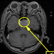 脑垂体瘤症状有哪些？如何治疗垂体瘤？