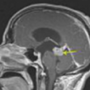 出国看病：质子治疗星形细胞脑胶质瘤效果卓著