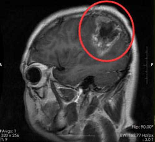 <a href='/qianyan/zhizizhiliao/' target='_blank'><u>质子治疗</u></a><a href='/bingzhong/jiaozhiliu/' target='_blank'><u>胶质瘤</u></a>