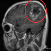 质子治疗胶质瘤是无创的吗？