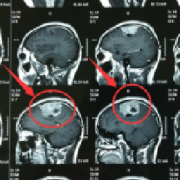 出国看病：左顶镰旁脑膜瘤手术未做干净怎么办？