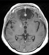 质子治疗可以对脑膜瘤合适么？