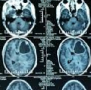 激光间质消融术治疗小儿癫痫及脑肿瘤