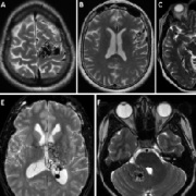 功能区亚型是否影响动静脉畸形手术的预后?