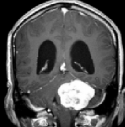 问：如果我有耳鸣但没有听力损失，我可能是听神经瘤吗？