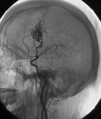 <a href='/bingzhong/ndjmjx/' target='_blank'><u>脑动静脉畸形</u></a>