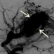 无症状脑动静脉畸形要治疗吗?