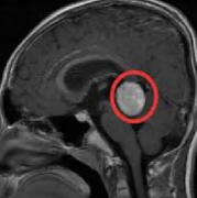 小儿松果体区肿瘤能治疗完全吗?