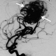 脑内动静脉畸形好发于哪些部位？