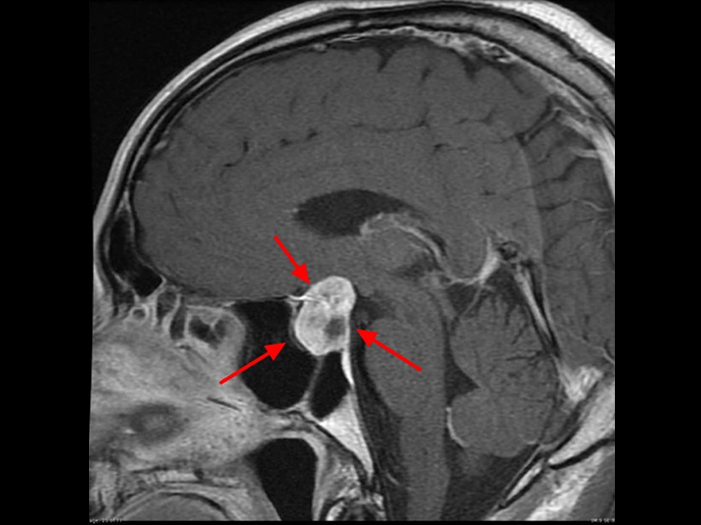垂体微腺瘤mri图像图片