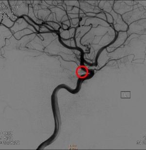 出国看病：脑动脉瘤严重吗?