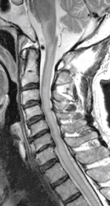 脊髓肿瘤一级复发