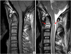 脊髓肿瘤一级复发了怎么办?