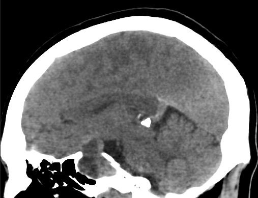 垂体瘤经蝶窦手术常见并发症