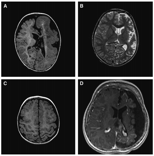 控制儿童顽固性癫痫的大脑半球切除术:单一机构两种手术技术的比较